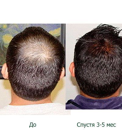 Лосьон для роста волос и бороды AZELOMAX (Азеломакс) 5% -60мл.